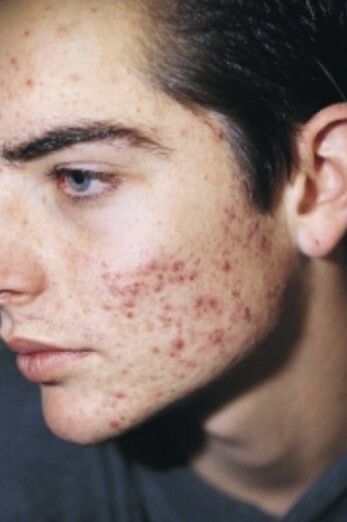 Girl With Acne, Acne Men, Thread Veins, Face Mapping Acne, Bad Skin, Acne Scarring, Problem Skin, Pimples On Face, Types Of Acne