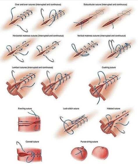 MEDICAL LIFE’s Instagram profile post: “Different types of suture technique.. . Hit the like button ❤and follow↗️ my page if you like ❤my contant.. .Mention your friends to see…” Stitches Medical, Surgical Stitches, Suture Techniques, Vet Tech School, Medical Life, Surgical Suture, Survival Ideas, Medicine Notes, Surgical Technologist