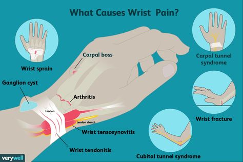 Wrist Fracture, Wrist Sprain, Cubital Tunnel Syndrome, Sprained Wrist, Wrist Pain Relief, Wrist Exercises, Wrist Pain, Hand Pain, Carpal Tunnel