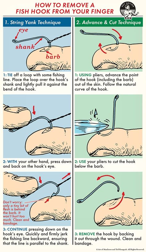 How to Remove a Fish Hook | The Art of Manliness How To Fish, Survival Skills Life Hacks, Art Of Manliness, Survival Life Hacks, Survival Techniques, Fish Hooks, Survival Life, Wilderness Survival, Medical Illustration