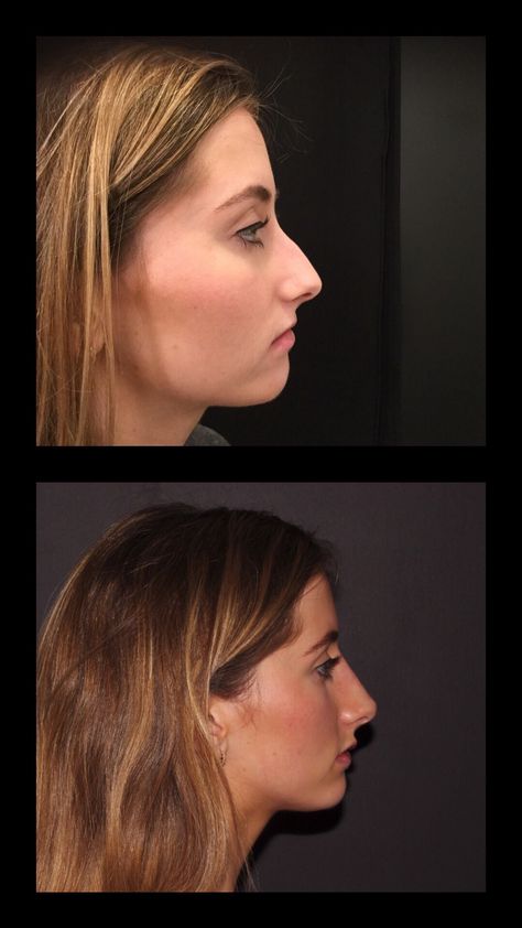 Nose Job Before And After Bump, Non Surgical Nose Job Before After, Nose Injections Before And After, Nose Job Before And After Front View, Filler Nose Job Before After, Botox Nose Before After, Nose Before And After, Liquid Nose Job Before And After, Nose Job Before And After Rhinoplasty