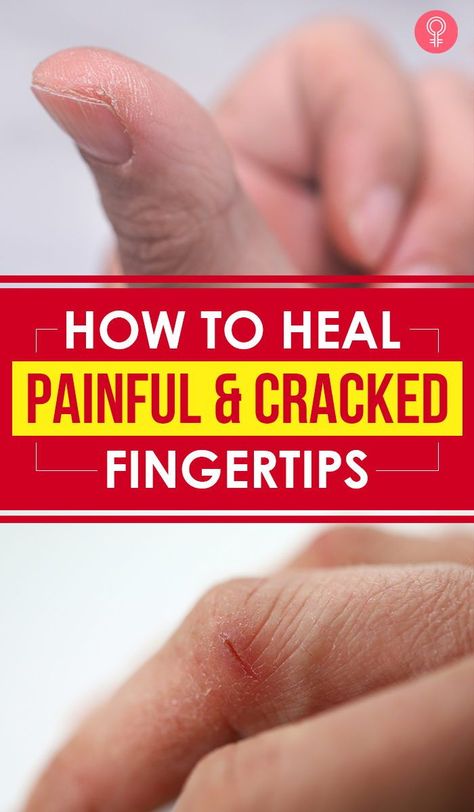 Dry Cracked Hands Remedy, Cracked Hands Remedy, Cracked Fingertips, Dry Hands Remedy, Cracked Fingers, Remedy For Sinus Congestion, Dry Cracked Hands, Chapped Hands, Cracked Hands