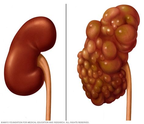 Polycystic kidney compared with normal kidney Polycystic Kidneys, Kidney Detox, Kidney Damage, Disease Symptoms, Kidney Health, Jairzinho, Herbal Remedies, Stevia, Healthy Life