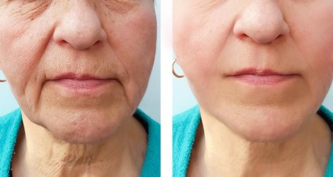 Marionette Lines Filler, Obličejové Masky, Mouth Wrinkles, Botox Before And After, Face Fillers, Marionette Lines, Skin Tightening Cream, Erase Wrinkles, Facial Fillers