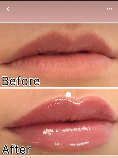 Full Lips Makeup, Facial Injections, Lip Permanent Makeup, Heart Shaped Lips, Lips Inspiration, Permanente Make-up, Botox Lips, Chubby Face, Beauty Procedures