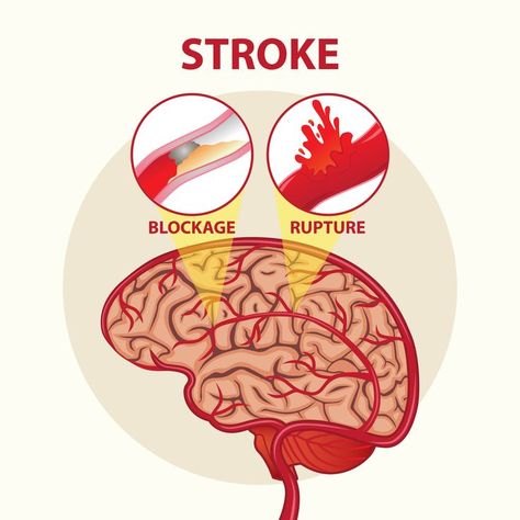 This vector or illustration image is suitable for health design for the stroke disease. The design can be for posters, flyers, brochures, appeals, prevention, displays, signs and billboards. #health #stroke #strokeday #vector #illustration #strokeblockage # strokerupture #medicine Brain Illustration, Foot Reflexology Massage, Vegan Probiotics, Reflexology Massage, Foot Reflexology, Healing Touch, Heart Illustration, Health Design, Illustrator Artist