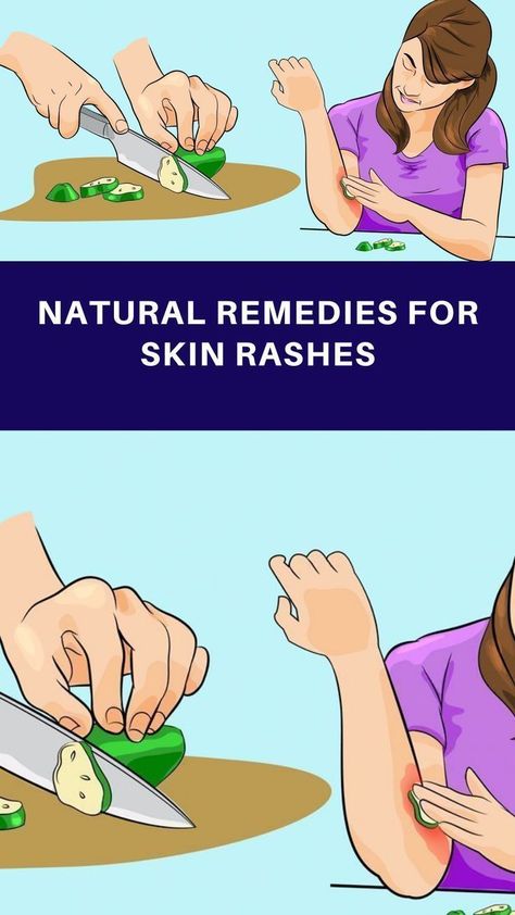 Skin Rash Remedies, Home Remedies For Rashes, Rashes Remedies, Remedies For Skin, Home Remedies For Allergies, Home Remedies For Warts, Warts Remedy, Autoimmune Disorders, Natural Remedies For Migraines