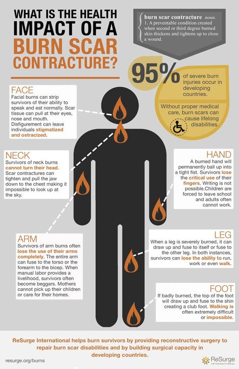 Ever heard of a burn scar contracture?  It's a preventable condition that happens when 2nd or 3rd degree burned skin thickens and tightens up to close a wound. Without access to proper medical care for burns, people with severe burns often end up disabled due to these contractures.  Find out what the health impacts are for a burn survivor, depending on where the contracture is located, in this infographic.  Please help us spread the word - repin this for your followers!  www.resurge.org/burn... Burn Victims Recovery, Burn Wound Reference Drawing, Burn Victim Art, Burn Unit Nurse, Burned Skin Reference, Burn Victim Character Art, Burned Skin Drawing, How To Draw Burn Scars, Characters With Scars