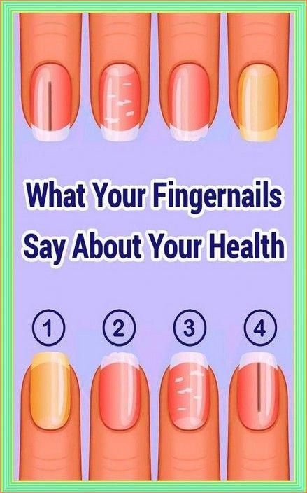 Your Nails Will Tell You If You Have Any of These Health Problems! Bluish Nails, Pitted Nails, Nail Symptoms, White Spots On Nails, Fingernail Health, John Brown, Medicine Book, Brittle Nails, Nail Plate