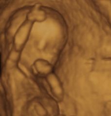 ultrasound of human fetus at 13 weeks and 5 days Babies Stuff, 13 Weeks Pregnant Ultrasound, 13 Weeks Pregnant Belly, Fetal Ultrasound, Pregnant Ultrasound, 13 Weeks Pregnant, Pregnancy Belly, Second Trimester, Nasal Congestion