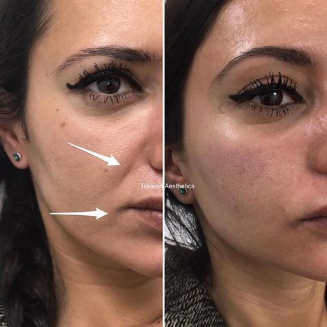 Face Injections, Face Plastic Surgery, Cosmetic Fillers, Cheek Bones, Rhinoplasty Nose Jobs, Face Fillers, Face Surgery, Botox Lips, Pretty Nose