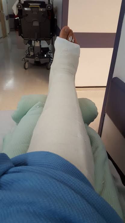 Broke Leg Snapchat, Ankle Cast, Walking Cast, Medical Boot, Long Leg Cast, Cafe Coffee Day, Fake Injury, Fake Ft Call, Broken Foot