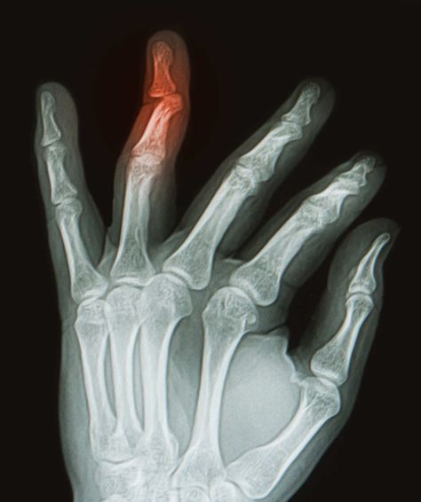 X-ray of hand with broken ring finger Broken Finger, Xray Art, Asthetic Picture White And Black, Pictures Of Plants, Young Farmers, Imperial College London, Hand Palm, Different Kinds Of Art, Meaningful Drawings