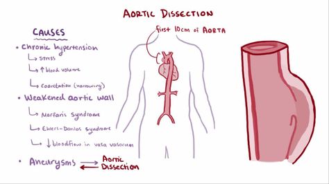 Aortic Dissection - Cardiovascular Disorders - Merck Manuals Professional Edition Subclavian Artery, Cardiovascular Disorders, Blood Pressure Control, Medical School Studying, Medical Knowledge, Cardiology, Lower Blood Pressure, Medical School, Blood Pressure