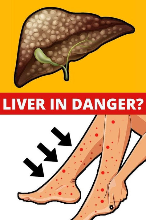 Signs such as confusion or memory problems, abdominal pain, unexplained joint pain, chronic fatigue, swelling in the legs and ankles can help to indicate an overworked liver. Overworked Liver, Liver Cleanse Juice, Liver Issues, Kidney Detox, Liver Diet, African Cooking, Saving Plan, Liver Failure, Liver Detoxification