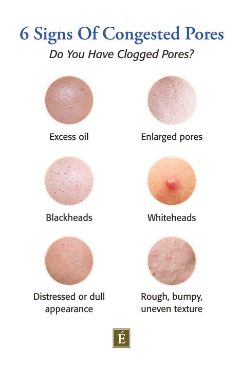 Graphic showing 6 types of clogged pores, including excess oil, enlarged pores, blackheads, whiteheads, distressed or dull appearance and rough, bumpy, uneven texture. Congested Pores Skincare, Congested Pores, Eminence Organic Skin Care, Beauty App, Congested Skin, Good Skin Tips, Professional Skin Care Products, Clogged Pores, Organic Skin