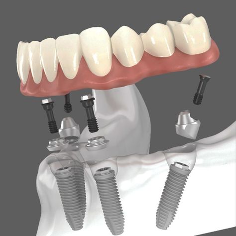 With the All-on-4 dental implant restoration method, patients have four to six dental implants placed in carefully planned locations in their mouth. Beautiful custom-designed dentures are secured to the implants, providing unparalleled stability to restore the patient’s teeth. 

Contact ☎️ (858) 481-5210
#SolanaSmiles #DentalImplants #AllOn4 Dental Implant Procedure, Implant Dentist, Denture Implants, Dental Implants Cost, Missing Teeth, Sunny Isles, Family Dental, Natural Teeth, Dentures