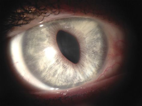 A 55-year-old woman noticed that her right pupil was oddly shaped, associated with a mild ache. Her afferent visual examination, ocular and eyelid motility, and fundi were normal. Her left pupil was round and reactive (figure 1). The right pupil was elongated (points at 11:00 and 5:00) and tonic (figure 2). There was no ocular hypertension or corneal edema. A year later, the pupil shape became triangular; Unique Pupil Shapes, Pupil Shapes, Eye Pupil, Reality Shifting, Pointed Ears, Neurology, Lighthouse, A Year, Life Hacks