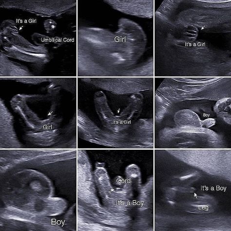 Ultrasound Boy Or Girl, Boy Ultrasound Pictures, Baby Gender Ultrasound, Pregnancy Boy Or Girl, Boy Or Girl Prediction, Boy Ultrasound, Pregnancy Gender Prediction, Diagnostic Medical Sonography Student, Body Changes During Pregnancy