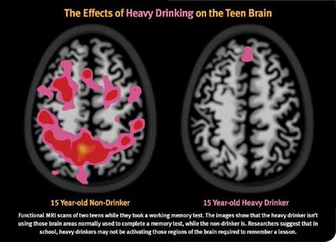 Risky Behavior, Teenage Brain, Memory Test, Heavy Drinking, Effects Of Alcohol, Colleges In Florida, White Matter, Mri Scan, Working Memory