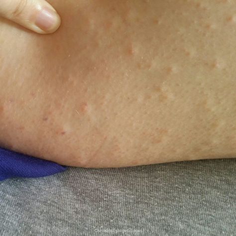 Red Spots All Over, Histamine Intolerance, Chronically Hopeful Allergic Reaction Rash, Keto Rash, Home Remedies For Face, Histamine Intolerance Symptoms, Allergy Rash, Rash On Face, High Histamine Foods, Histamine Intolerance, Mast Cell Activation Syndrome