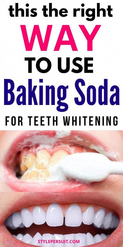 How To Use Baking Soda To Whiten Your Teeth: if you want to explore natural teeth whitening treatments, baking soda is a great option. Read on to know more about the benefits of using baking soda to get pearly white teeth. #teethwhitening #whiteteeth #remedies #homeremedies White Teeth Baking Soda, Natural Remedies For Cavities, Pearly White Teeth, Natural Teeth Whitening Diy, Baking Soda Teeth Whitening, Teeth Remedies, Teeth Whitening Homemade, Gut Healing Recipes, Teeth Whitening Remedies