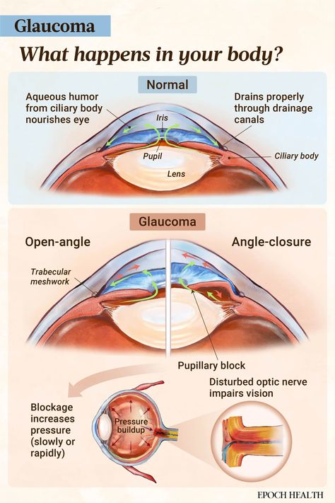 Glaucoma: Symptoms, Causes, Treatments, and Natural Approaches | The Epoch Times Eye Health Facts, Eye Health Remedies, Eye Medicine, Human Skeletal System, Medicine Logo, Eye Facts, Medical Transcription, Eye Pain, Eye Vitamins