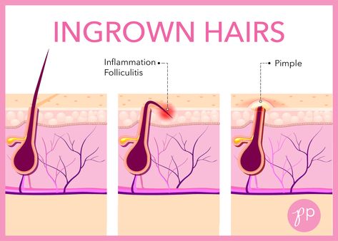 Most Ingrown Hairs straighten out within a week or two. If an ingrown hair persists or becomes infected, check with your doctor. Ingrown Hair Armpit, Treat Ingrown Hair, Electrolysis Hair Removal, Prevent Ingrown Hairs, Ingrown Hairs, Improve Skin Texture, Moisturizing Body Wash, Anime Hair, Roots Hair