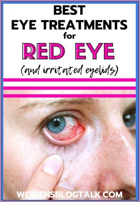 How To Get Rid Of Red Eyes Eye Redness Remedies, Red Rimmed Eyes, Eye Drops For Red Eyes, Red Around Eyes, Irritated Eyes Remedies, How To Get Rid Of Red Eyes, Oily Eyelids How To Get Rid Of, Red Veins In Eyes, Dry Eyes Remedy Natural Treatments