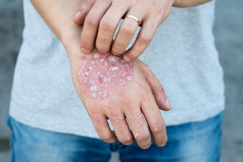 Immunotherapy strategy offers hope to autoimmune skin disease sufferers Home Remedies For Skin, Dry Flaky Skin, Skin Disorders, Flaky Skin, Skin Diseases, Skin Conditions, Doterra, Disease, Skin