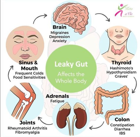 Keto A Vie on Instagram: "9 Leaky Gut Symptoms Problems in our gastrointestinal (GI) tract can cause more than just stomach pain 😥, gas 🤢, bloating, or diarrhea; they can be the root cause of many chronic health problems. If your intestinal wall has been compromised, and you have leaky gut, you’ll likely experience these symptoms and signs: 1. Digestive issues such as gas, bloating, diarrhea, or irritable bowel syndrome (IBS) 2. Food allergies 🤧 or food intolerances. 3. Brain fog 🧠 difficult Painful Gas, Herbalife Aloe, Leaky Gut Symptoms, Gut Problems, Digestive Issues, Gi Tract, Irritable Bowel, Seasonal Allergies, Food Intolerance