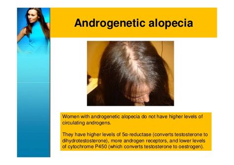 Androgenetic alopecia in Women ...scary because this type of hair probably will never grow back Androgenic Alopecia, Thick Hair Growth, Thick Hair Remedies, Androgenetic Alopecia, Male Pattern Baldness, Hair Remedies For Growth, Pattern Baldness, Female Hair, Grow Long Hair