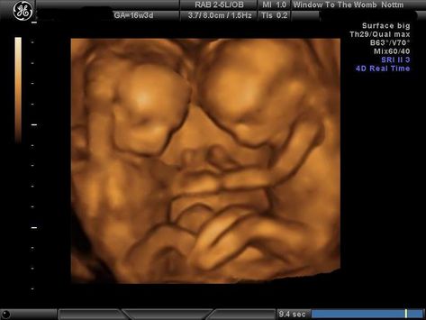 Tiny 16 week 3d ultrasound images. Identical Twins Ultrasound, Twin Baby Loss, Twins In The Womb, Stomach Picture, Twins Ultrasound, Baby Ultrasound Pictures, 3d Ultrasound, Mommy And Baby Pictures, Baby Ultrasound