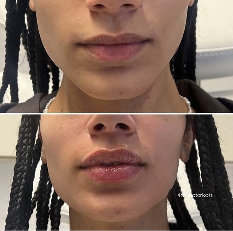 Narrow Mouth Lip Filler, Lip Filler Shape Ideas Black Women, 1.5 Ml Lip Filler, Defined Cupids Bow Lip Filler, Lip Filler Before And After Black Women, Lip Filler Before And After 1ml, Natural Lip Fillers 1ml, Lip Filler Black Women, Natural Lip Fillers 0.5ml