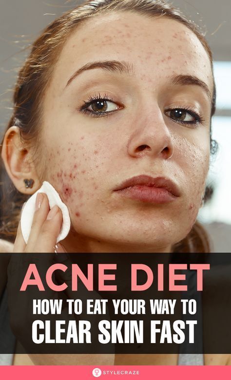 Anti Acne Diet, Acne Reasons, Clear Skin Diet, Clear Skin Fast, Acne Diet, Skin Diet, Acne Vulgaris, Natural Acne Remedies, How To Get Rid Of Pimples