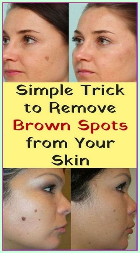 Simple Trick To Remove Brown Spots From Your Skin Sun Spots On Skin, Black Spots On Face, Sunspots On Face, Brown Age Spots, Age Spot Removal, Brown Spots On Skin, Spots On Legs, Brown Spots Removal, Brown Spots On Face