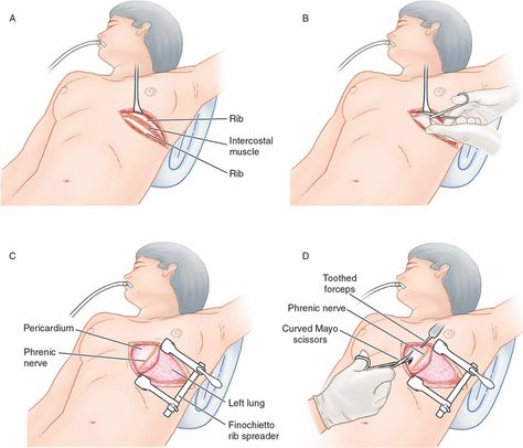 Learn about thoracotomy - a surgical procedure involving chest incision, its uses, recovery, and key medical insights - #chestcavityaccess #chestcavityoperation #chestcavitysurgery #chestincision #chestincisionprocedure #chestoperation #chestsurgery #chestwallsurgery #lungsurgery #Medicalprocedure #patientoutcomes #recoveryprocess #surgicalintervention #surgicaltechnique #thoracicprocedure #thoracicsurgery Thoracic Cavity, Surgical Procedures, Primary Care Physician, Heart Conditions, Vital Signs, Scar Tissue, Chest Pain, Patient Experience, Primary Care