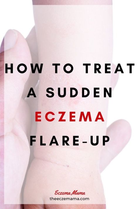 How to Treat a Sudden Eczema Flare-up - Eczema Mama #eczema #foodallergies #babyeczema #parenting Lotion Diy, Natural Remedies For Migraines, Dry Skin Remedies, Wound Care, Skin Remedies, Itchy Skin, Kids Health, Baby Hacks, Care Routine