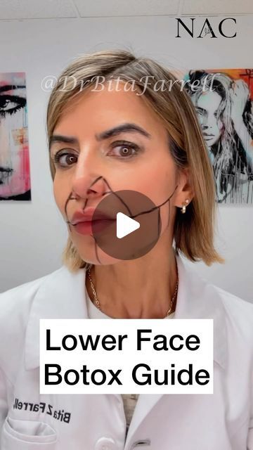 Dr. Bita Zadeh Farrell on Instagram: "Botox or any other brand of Neuromodulator can be used in the lower face.  These are guidelines and dosing can vary between individuals.   #botoxtraining #lowerfacebotox #botoxunits #drbitafarrell #naturalaestheticscenter" Dao Muscle Botox Before And After, Botox For Marionette Lines, Lower Face Botox Before And After, Where To Get Botox On Face, Botox Mapping, Botox Before After, Botox Aesthetic, Botox Training, Botox Before And After