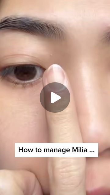 Sirak Darbinian, MD on Instagram: "This is how to manage Milia …" How To Get Rid Of Milia On Face, Milia Removal Remedies, Millia Removal, Milia Removal, Cystic Acne On Chin, Natural Body Care, Clearer Skin, Cystic Acne, Effective Skin Care Products