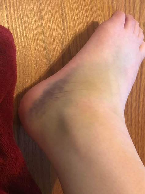 Ankle Injury Snapchat, Hand Swelling Snapchat, Leg Swelling Snapchat, Injured Leg Fake Story, Injured Snapchat Story, Fractured Leg Broken Foot, Injured Leg, Sprained Ankle Snapchat, Leg Broken