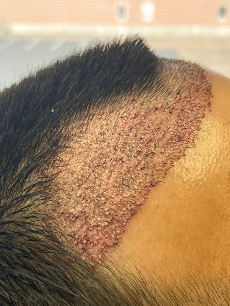 Hair Transplant ⁠⚡️ using microFUE™️⁠ Call to schedule your FREE consultation⁠ 📞1-800-313-4247⁠ ⁠⚡️Contact button in bio ⁠ ⁠ WhatsApp⁠: 🇵🇹🇧🇷🇪🇸5088979996⁠ #microfue #fuehairtransplant #hairtransformation #hairtransplantUSA #hairtransplantboston #hairline #hairsurgery #menshair #menshairloss #thinninghair #hairlosssolution #hairrestoration #hairreplacement #selfcare #medspa #boston #fue #hairgrowth #restoration #hairtransplant #hairtransplantturkey #follicles⁠ #fueeurope Hairtransplant Men, Hair Transplant Before And After, Hairline Transplant, Hair Surgery, Hair Transplant Results, Bio Whatsapp, Fue Hair Transplant, Hair Replacement, Hair Transplant