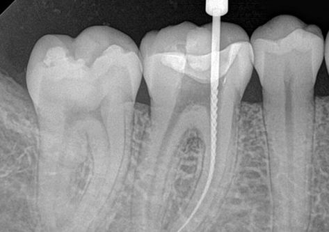 Safer and Healthier Alternatives to Root Canals and Other Common, Yet Harmful, Tooth Restoration Techniques | Wake Up World Dental Hospital, Oral Surgeon, Dental Braces, Emergency Dentist, Dental Crowns, Dental Surgery, Root Canal, After Life, Dental Office