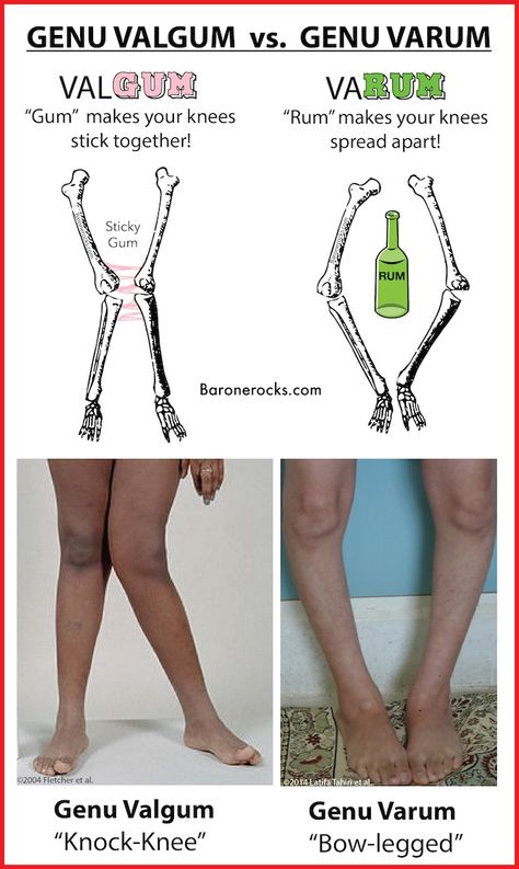 Genu Valgum vs. Genu Varum Genu Valgum, Genu Varum, Physical Therapy School, Radiology Student, Physical Therapy Student, Medical Mnemonics, Physical Therapy Assistant, Medical Student Study, Human Body Anatomy