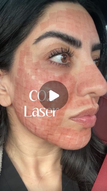 Skinfx Medical Spa on Instagram: "CO2 skin resurfacing is a cosmetic procedure that uses a carbon dioxide (CO2) laser to remove layers of skin in a precise manner. 

This process helps to improve skin tone, texture, and appearance by stimulating collagen production and promoting skin regeneration. It can be used to treat various skin issues such as wrinkles, fine lines, scars, sun damage, and uneven pigmentation. 

However, it typically requires some downtime for the skin to heal properly.

I got mine done at @dmhaesthetics by @dr.o.aesthetics 🖤

Would you try this procedure?👇🏻" Laser Scar Removal Before And After, Skin Regeneration, Skin Resurfacing, Improve Skin Tone, Cosmetic Procedures, Medical Spa, Layers Of Skin, Carbon Dioxide, Collagen Production