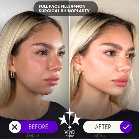 💉✨ Sculpt and define your face with Jawline Filler at Vivid Clinic! Check out this stunning Client Transformation—perfectly contoured, sharper jawline for a more defined and balanced appearance. 💎 ✅ Enhances facial definition ✅ Non-surgical with immediate results ✅ Long-lasting, natural-looking transformation 💬 Want to achieve a similar look? Book your free consultation today and take the first step toward a more sculpted you! 📍Located in Istanbul, Turkey 🌐 vividclinic.net 📞 🇺🇸 +90 545 742... Jawline Contouring Filler, Chin And Jawline Fillers, Receding Jawline, Facial Contouring Fillers, Facial Balancing Before And After, Jaw Filler Before And After, Face Balancing Fillers, Jawline Fillers Before And After, Facial Balancing Filler