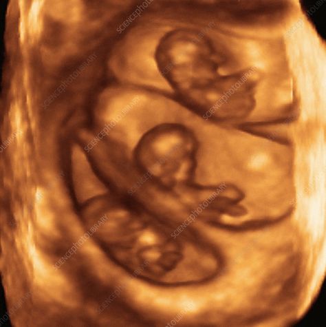 3d Ultrasound, 4d Ultrasound, Baby Ultrasound, Triplet Babies, Baby Scan, Science Photos, Cute Stories, Baby Family, Mom Kid