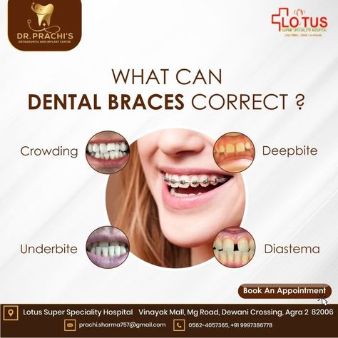 Braces are dental tools that help correct problems with your teeth, like crowding, crooked teeth, or teeth that are out of alignment. As you wear them, braces slowly straighten and align your teeth so you have a normal bite. Know More Consult Our Specialist🦷 . Best Dental Clinic in Agra! #dentalhealth #dentalcare #dentalclinic #dentalfacts #dentalhygiene #dentalcrowns #rootcanalspecialist #toothcavity #dentalissues #dentalclinicssafety Clove Dental, Dentist Social Media, Dental Advertising, Dental Social Media, Dental Implant Procedure, Dental Posts, Dental Posters, Dentist Clinic, Laser Clinic