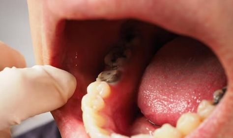 belmont dentistry scottsdale answers what are the signs of sepsis from tooth infection Dental Sealants, Dental Infection, Tooth Infection, Tooth Filling, Tooth Cavity, Dry Socket, Acid Reflux Diet, Dental Cavities, Tooth Removal