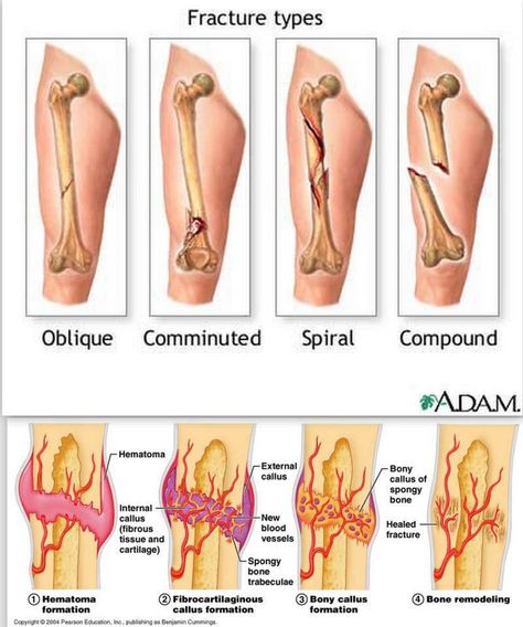 Fracture types and Stages of healing: All fractures can be broadly described as: Closed (simple) fractures: are those in which the sk... Types Of Fractures, Emt Study, Fracture Healing, Bone Fracture, Nursing Mnemonics, Emt Paramedic, Medical Student Study, Musculoskeletal System, Medicine Student